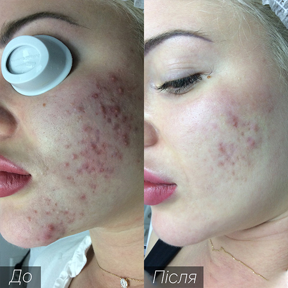 Процедура: Лікування акне Кількість процедур: 4 Лікар: Оксана Самотос