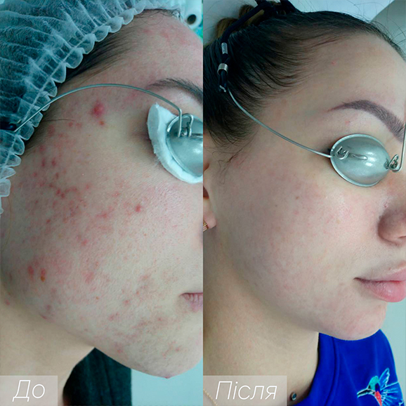 Процедура: Лазерне омолодження/ шліфування Кількість процедур: 4 Лікар: Вікторія Збірко