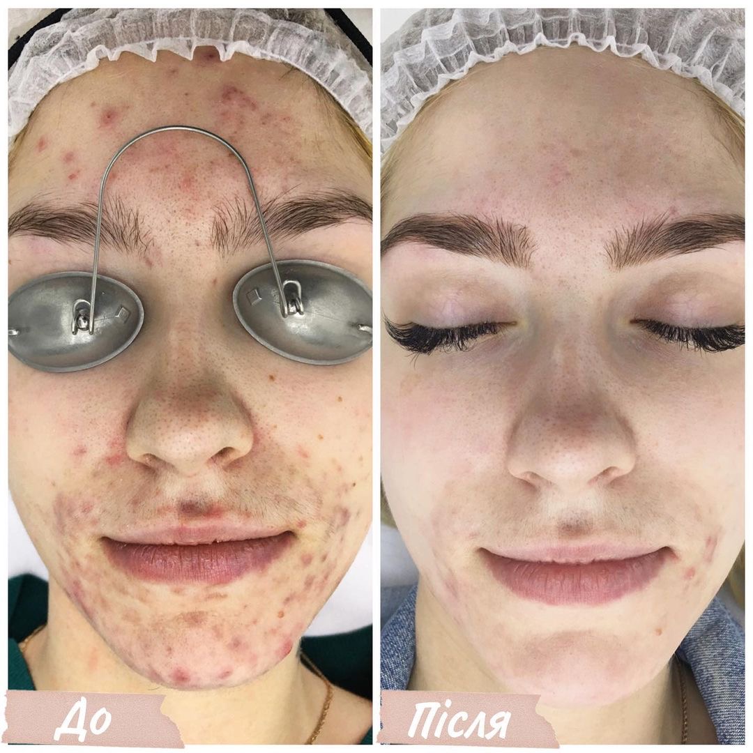 Процедура: Лікування акне Кількість процедур: 5 Лікар: Наталія Синюк