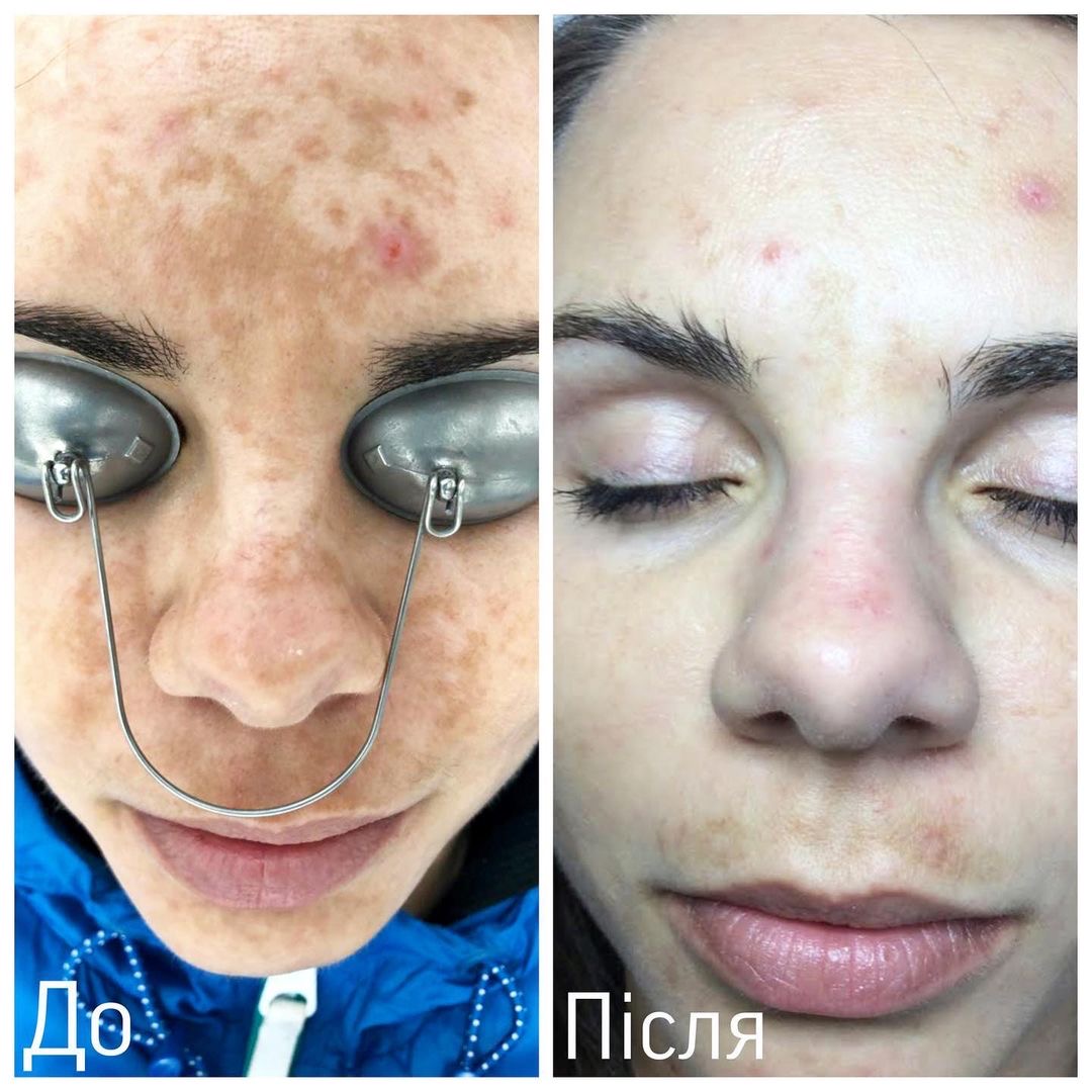 Процедура: Фотоомолодження/видалення пігментації Обладнання: BBL Sciton Кількість процедур: 3 Лікар: Вікторія Збірко