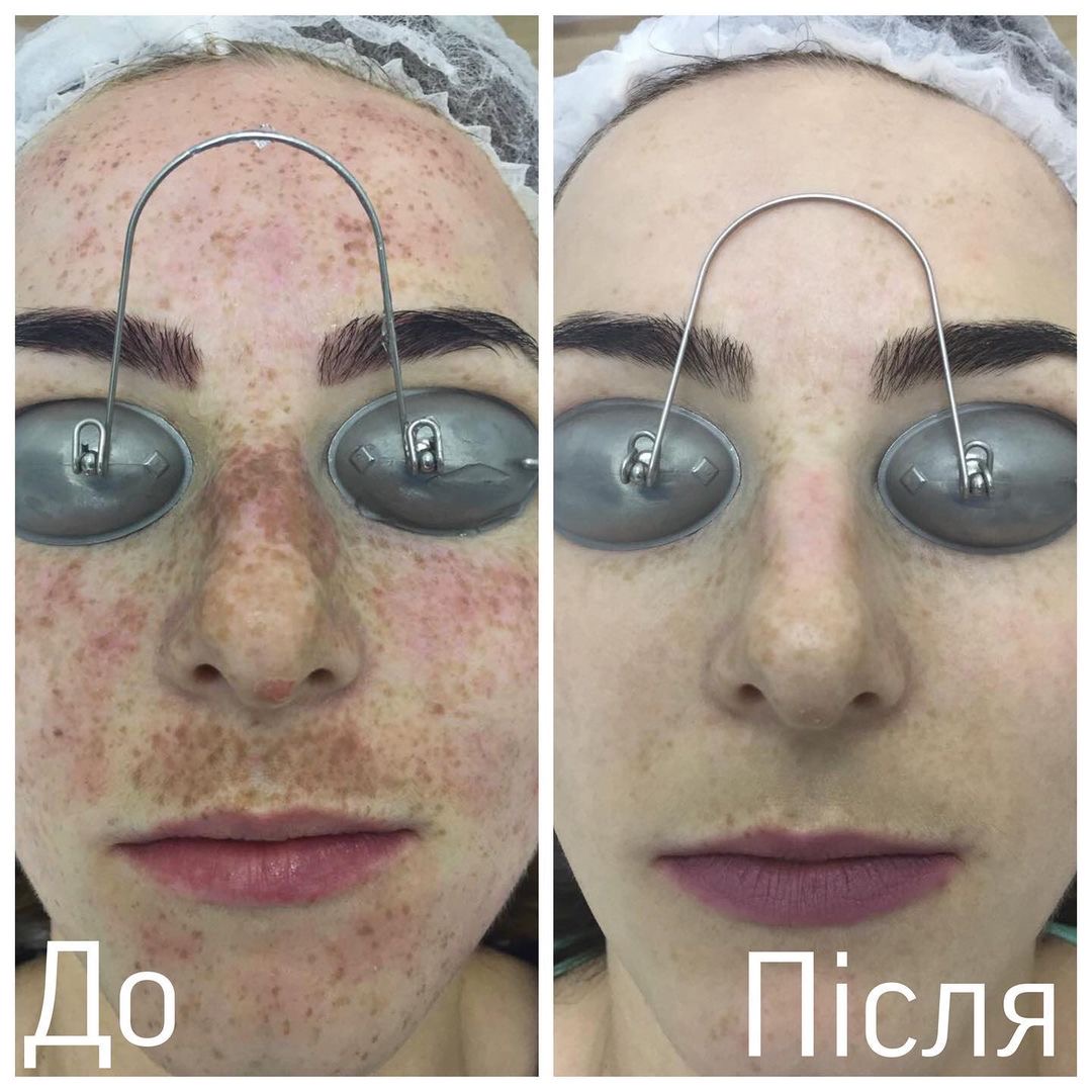 Процедура: Фотоомолодження/видалення пігментації Обладнання: BBL Sciton Кількість процедур: 3 Лікар: Наталія Синюк