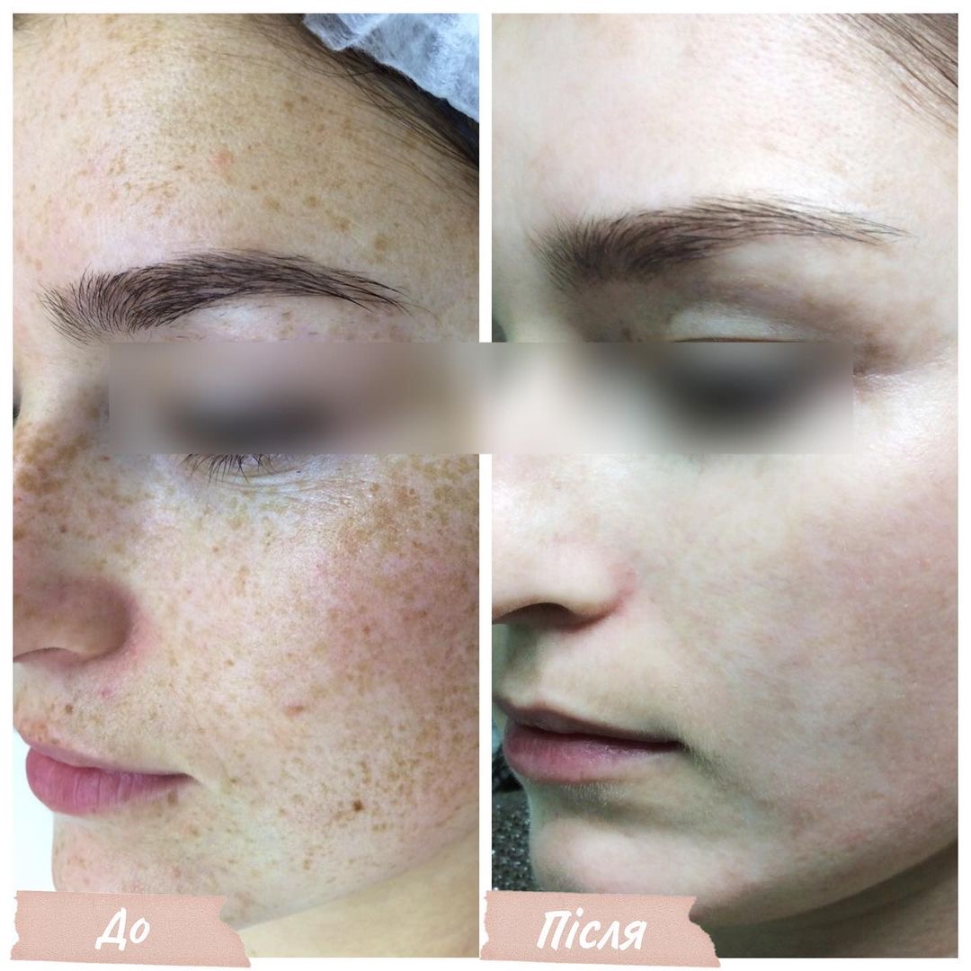 Процедура: Фотоомолодження/видалення пігментації Обладнання: BBL Sciton Кількість процедур: 1 Лікар: Оксана Самотос
