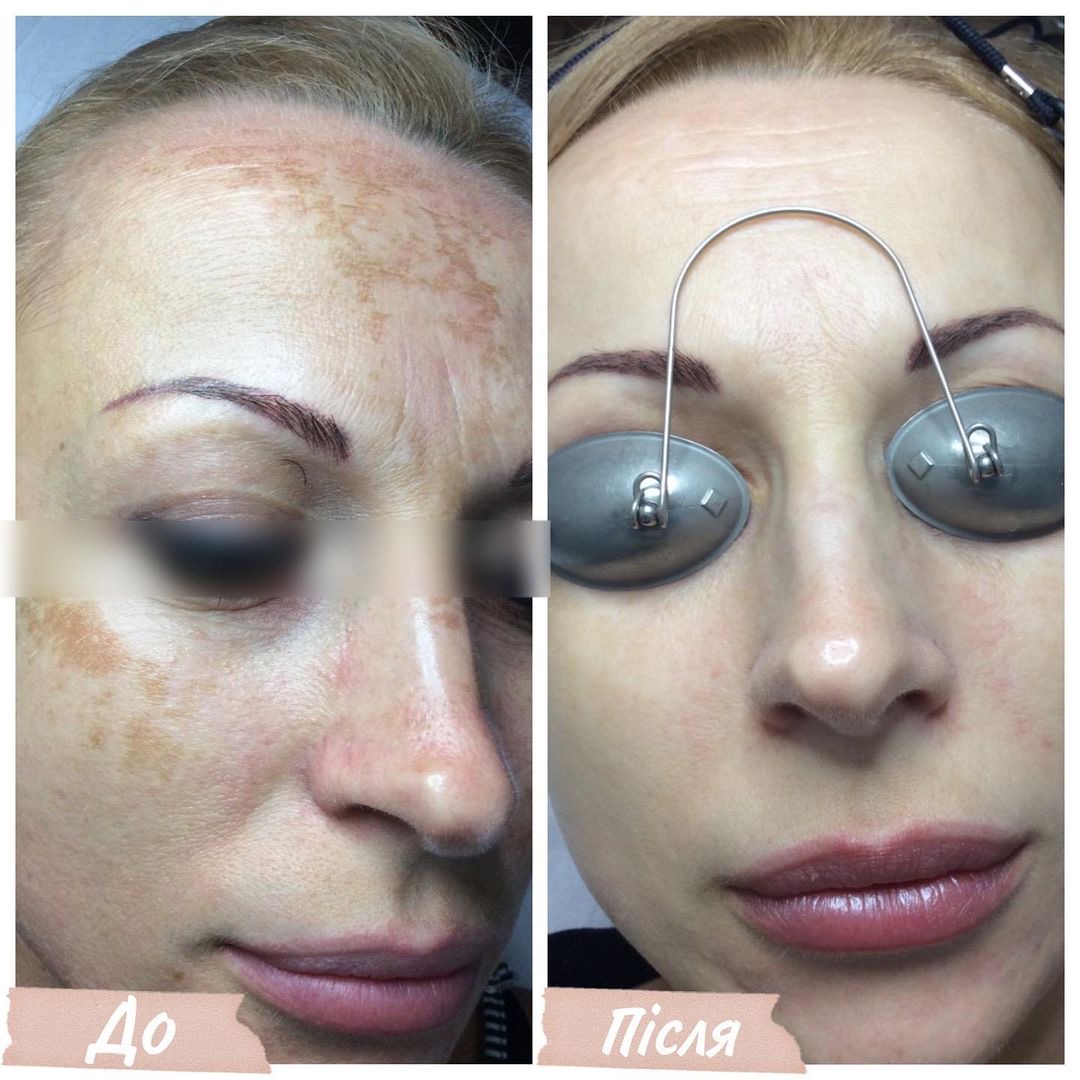 Процедура: Фотоомолодження/видалення пігментації Обладнання: BBL Sciton Кількість процедур: 2 Лікар: Олександра Гугусь