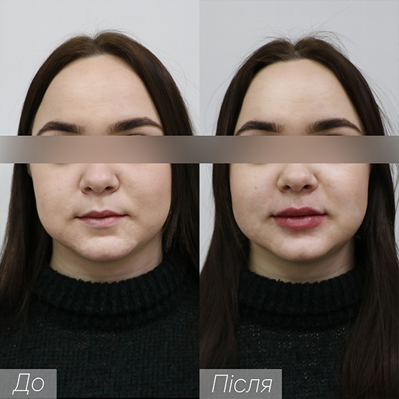 Врач: Гугусь Александра Процедура: Контурная пластика губ Препарат: Belotero Lips Shape 0,6ml Количество процедур: 1