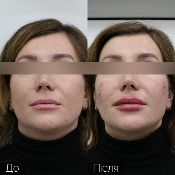 Врач: Гугусь Александра Процедура: Контурная пластика губ Препарат: Teosyal KISS 1ml Количество процедур: 1