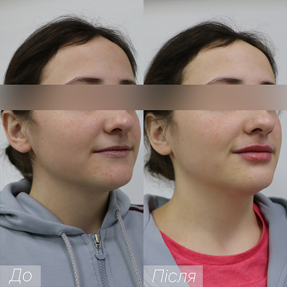 Врач: Самотос Оксана Процедура: Контурная пластика губ Препарат: Juvederm Ultra 3 1ml Количество процедур: 1
