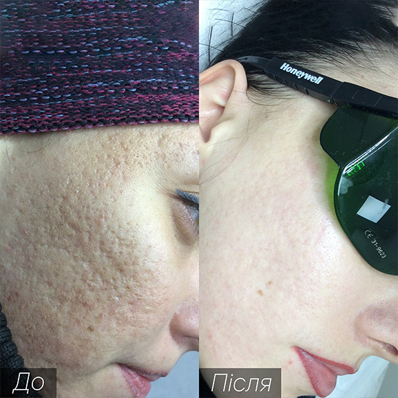 Процедура: Лазерне омолодження/ шліфування Кількість процедур: 5 Лікар: Наталія Синюк