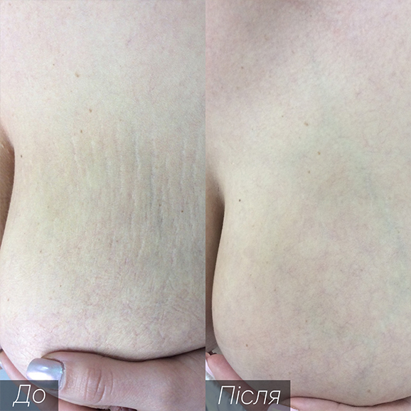 Процедура: Лазерная шлифовка Количество процедур: 2 Врач: Синюк Наталья