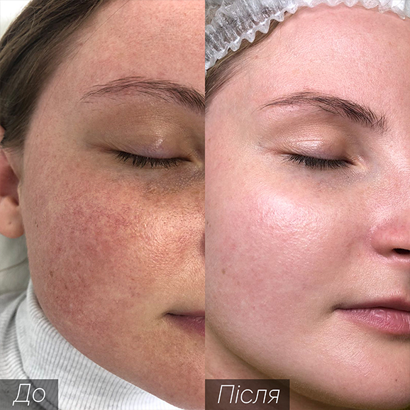 Процедура: фототерапія/термоліфтинг Кількість процедур: 2 Лікар: Збірко Вікторія