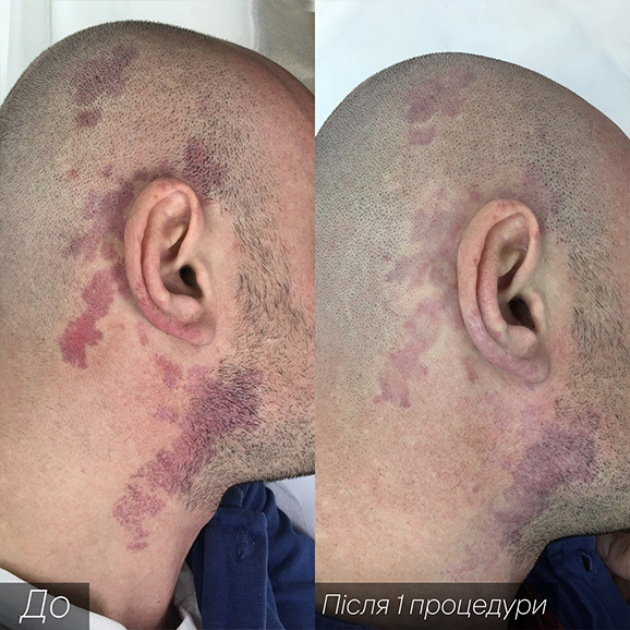 Процедура: Удаление сосудов Количество процедур: 3 Врач: Наталья Синюк