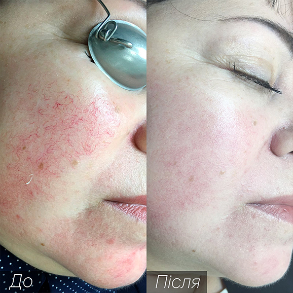 Процедура: Удаление сосудов Количество процедур: 1 Врач: Оксана Самотос