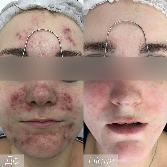 Процедура: Лікування акне Кількість процедур: 3 Лікар: Наталія Синюк