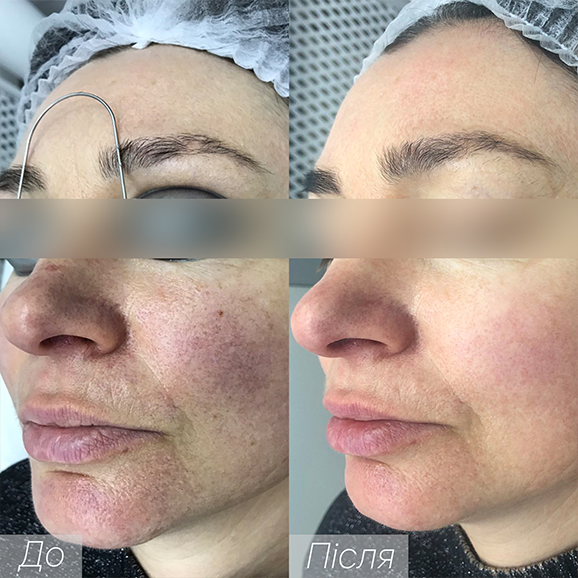 Процедура: фототерапія/термоліфтинг Кількість процедур: 3 Лікар: Харко Ольга