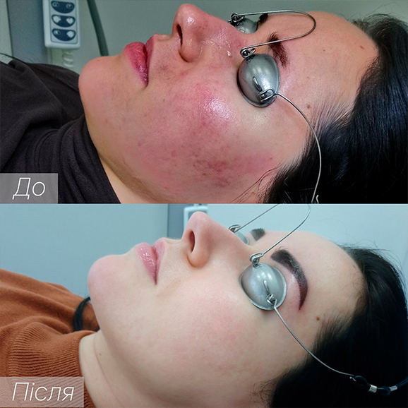 Процедура: Удаление сосудов Количество процедур: 4 Врач: Наталья Синюк