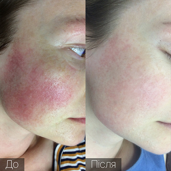 Процедура: Удаление сосудов Количество процедур: 2 Врач: Оксана Самотос