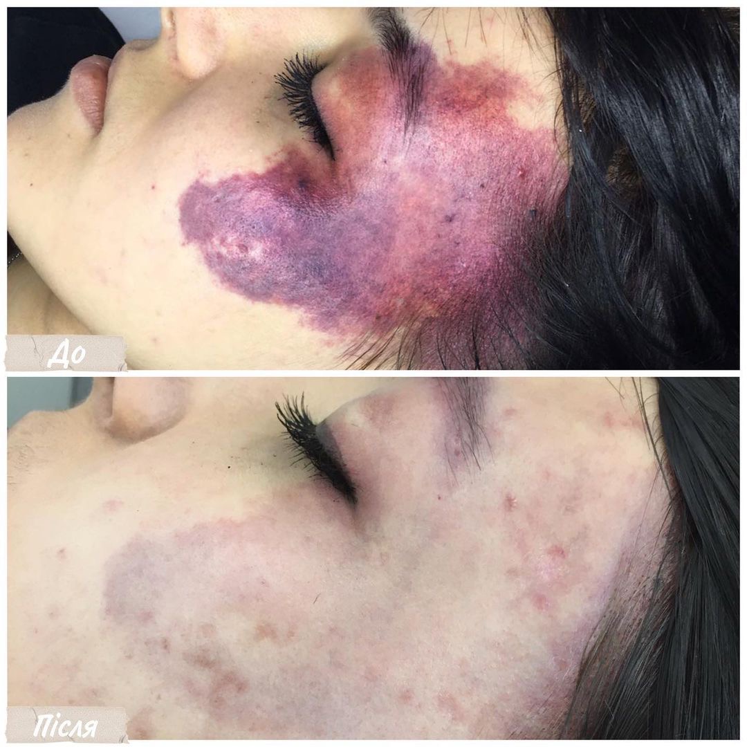 Procedure: Vascular Removal Number of Procedures: 4 Doctor: Viktoriya Zbirko