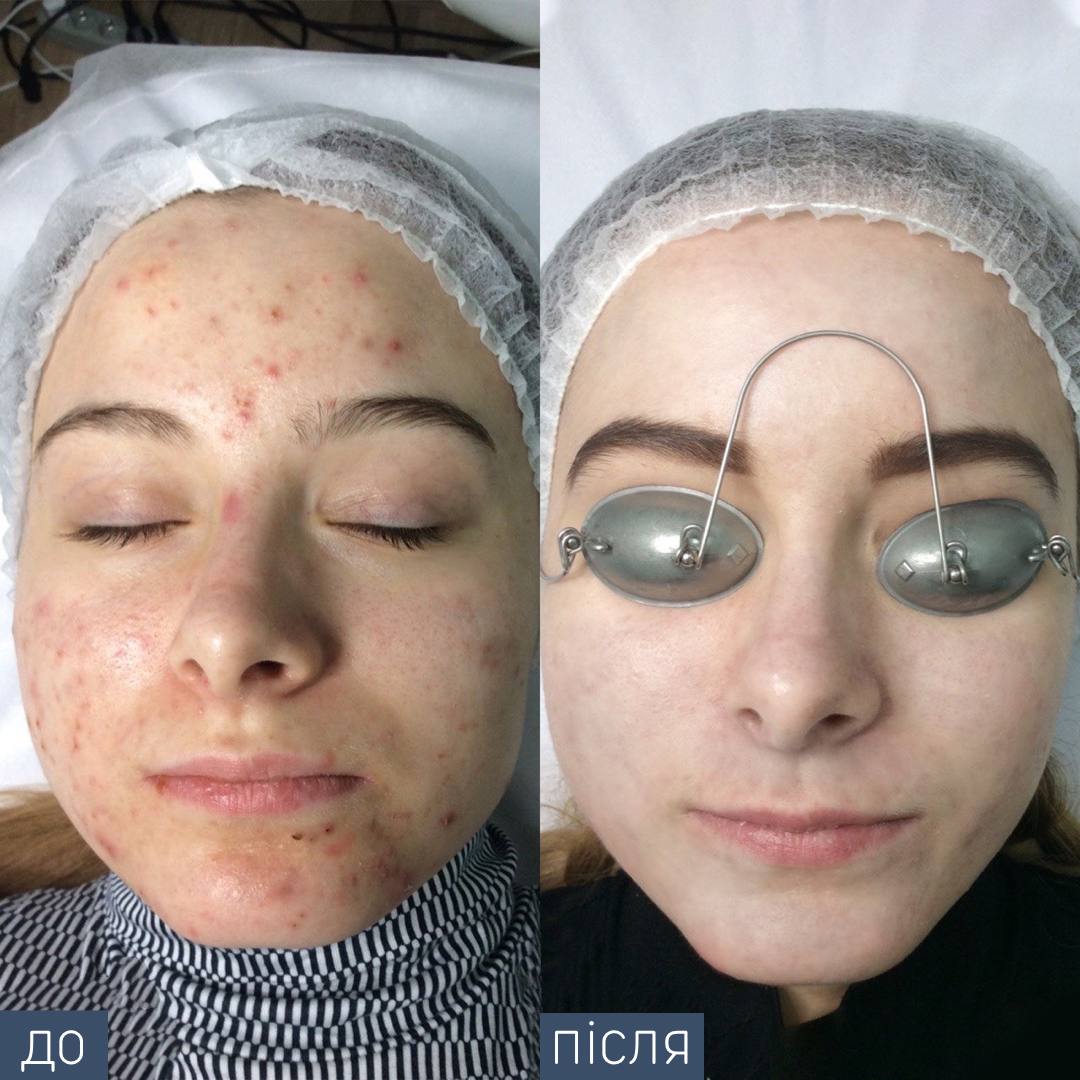 Процедура: консультація дерматолога+ курс процедур