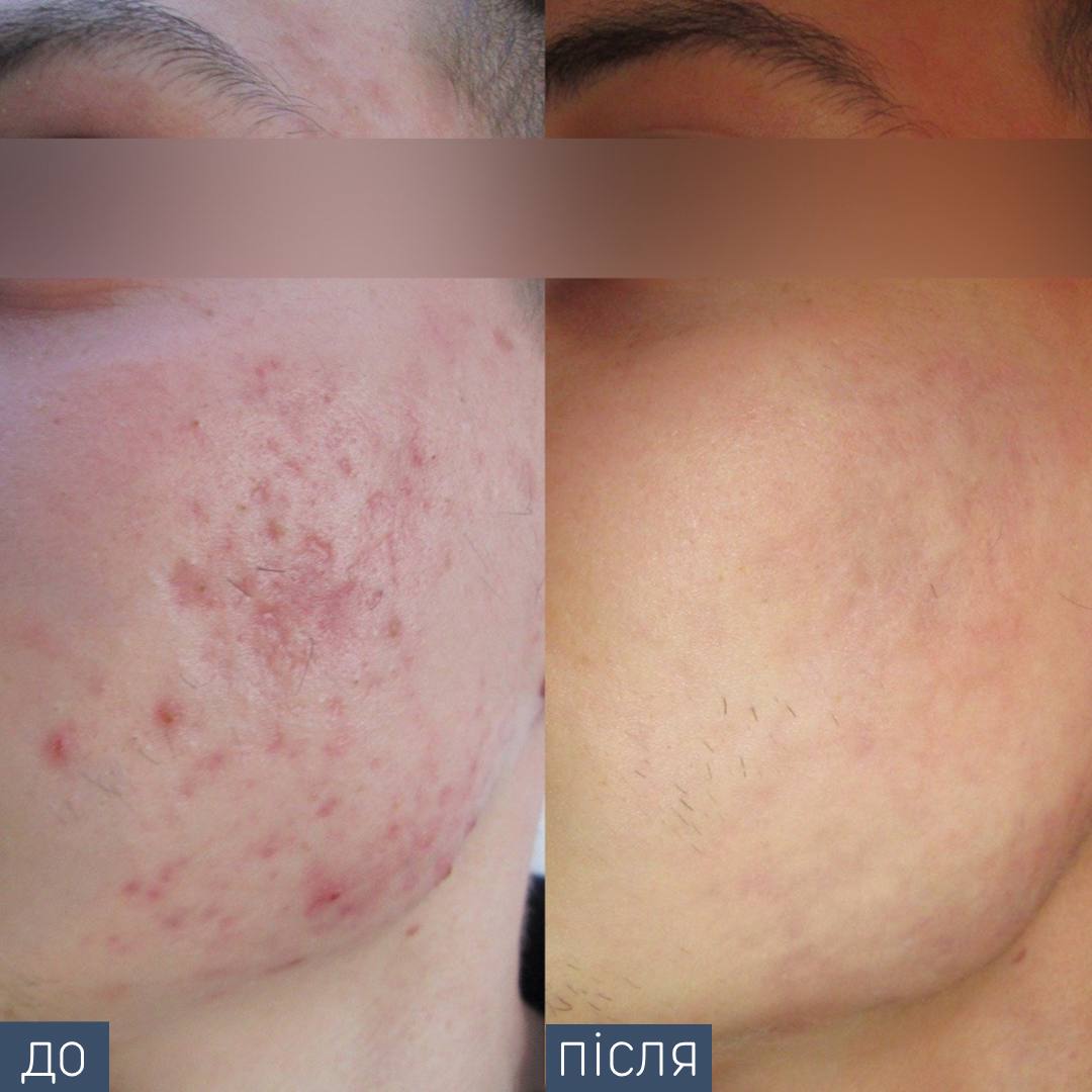 Процедура: Лікування акне Кількість процедур: 4 Лікар: Олександра Гугусь