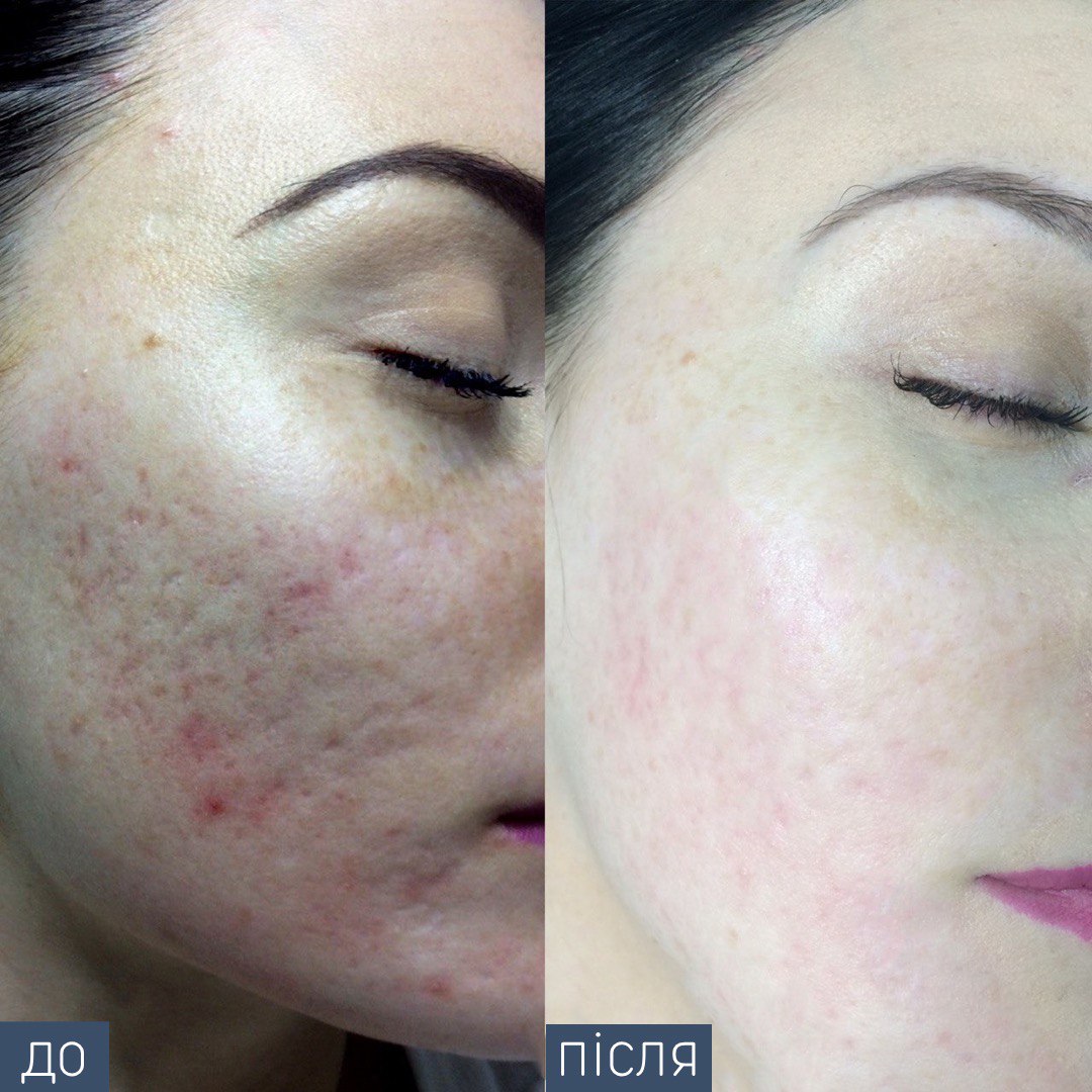 Процедура: консультация дерматолога+ курс процедур