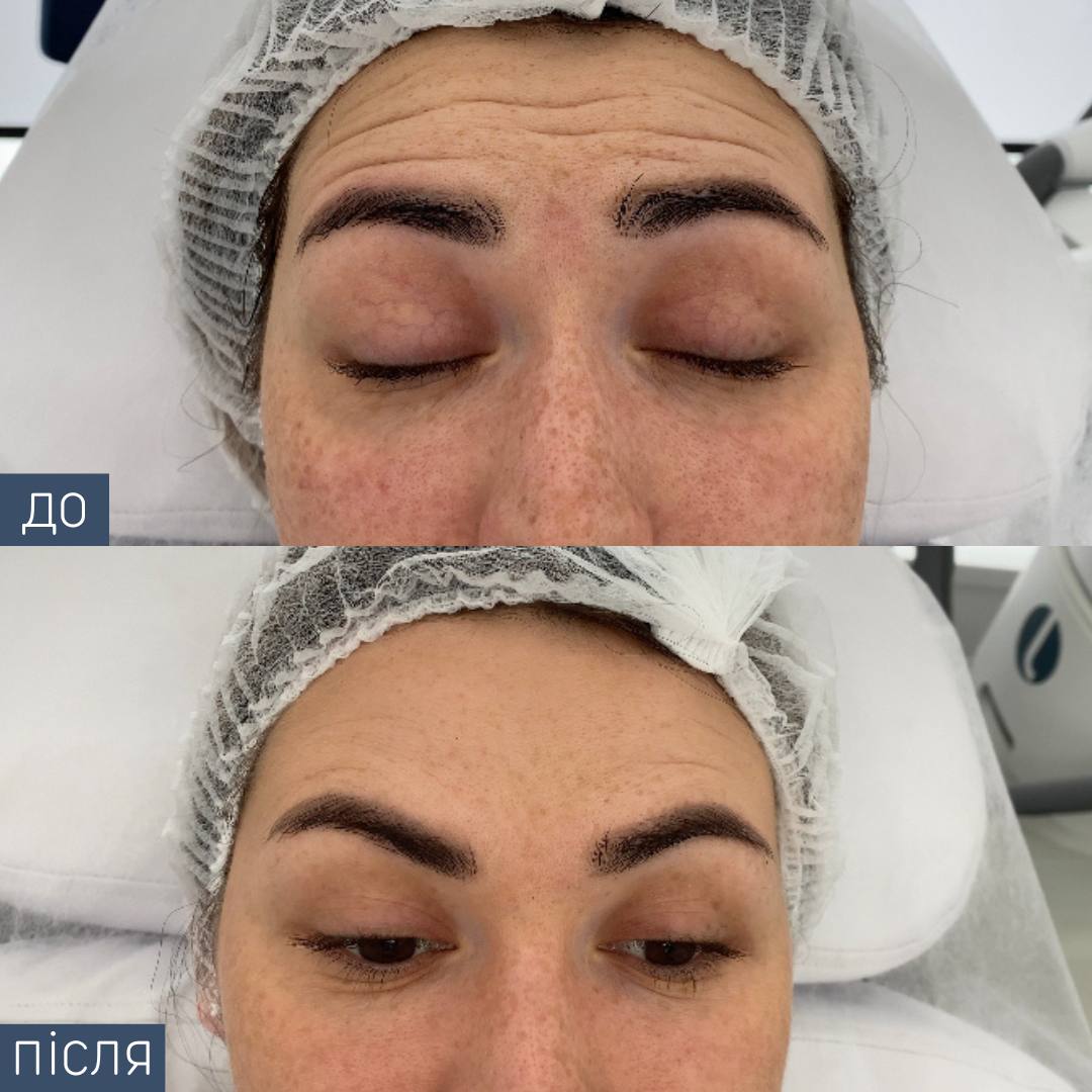 Procedure: Botulinum toxin injections Drug: Dysport IPSEN Number of procedures: 1 Doctor: Viktoriya Zbirko