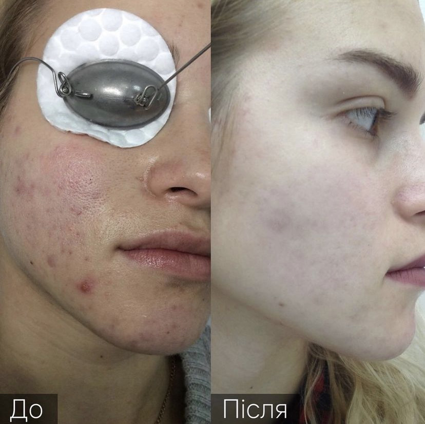 Процедура: Лікування акне Кількість процедур: 3 Лікар: Наталія Синюк