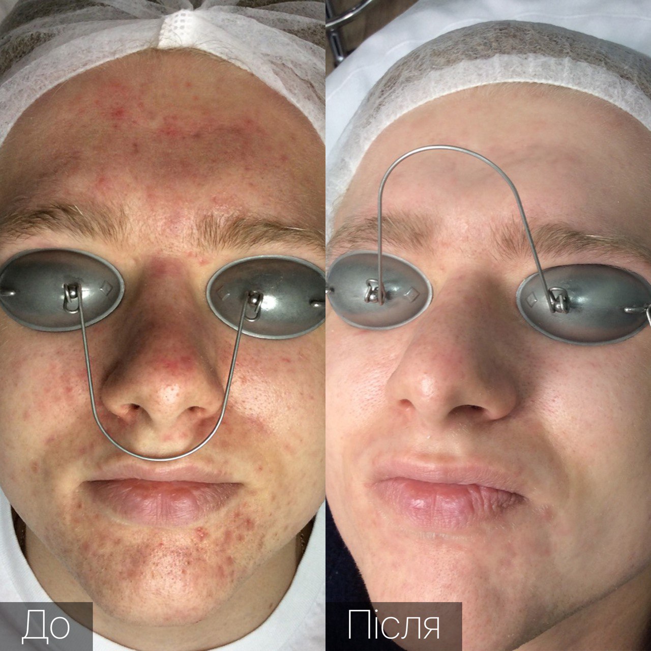 Процедура: Лікування акне Кількість процедур: 3 Лікар: Вікторія Збірко