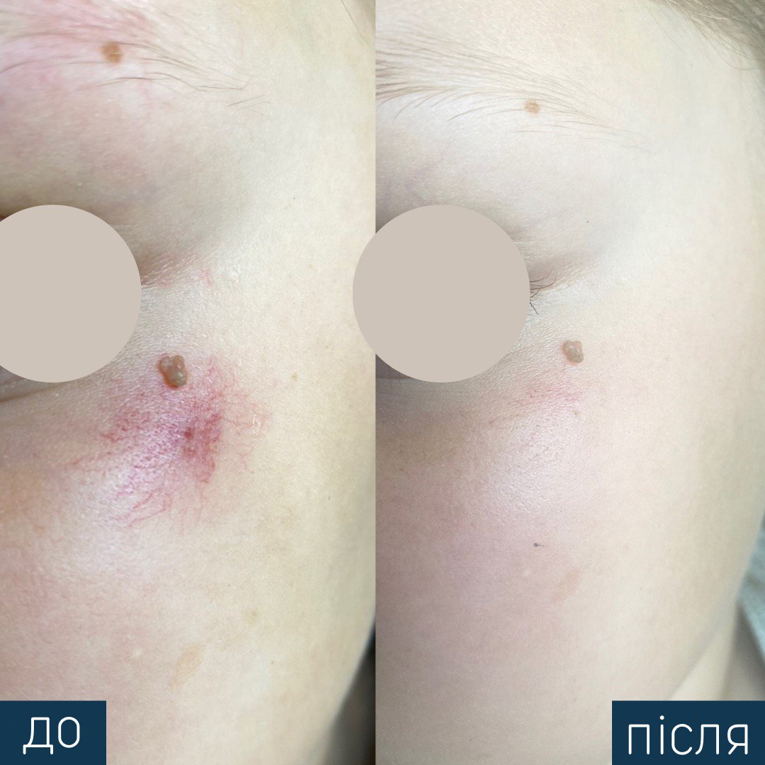 Procedure: Vascular Removal Number of Procedures: 1 Doctor: Olga Kharko