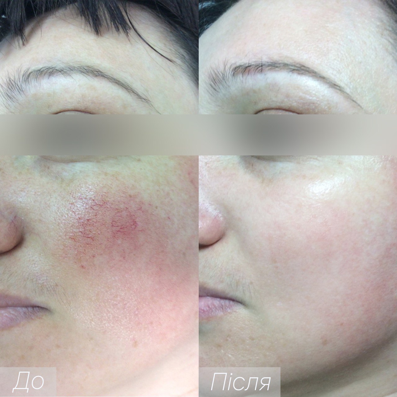 Процедура: Удаление сосудов Количество процедур: 2 Врач: Александра Гугусь