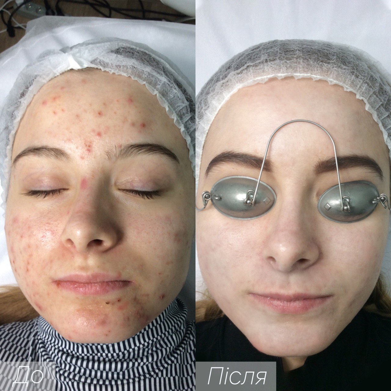 Процедура: фототерапия Количество процедур: 4 Врач: Самотос Оксана