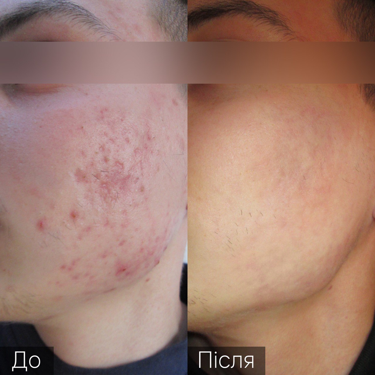 Процедура: Лазерне омолодження/ шліфування Кількість процедур: 4 Лікар: Олександра Гугусь