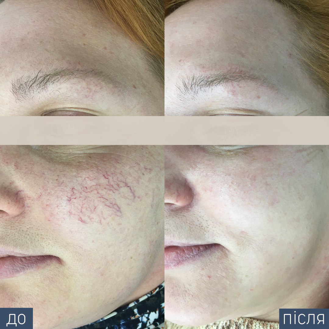 Процедура: Удаление сосудов Количество процедур: 1 Врач: Виктория Збирко