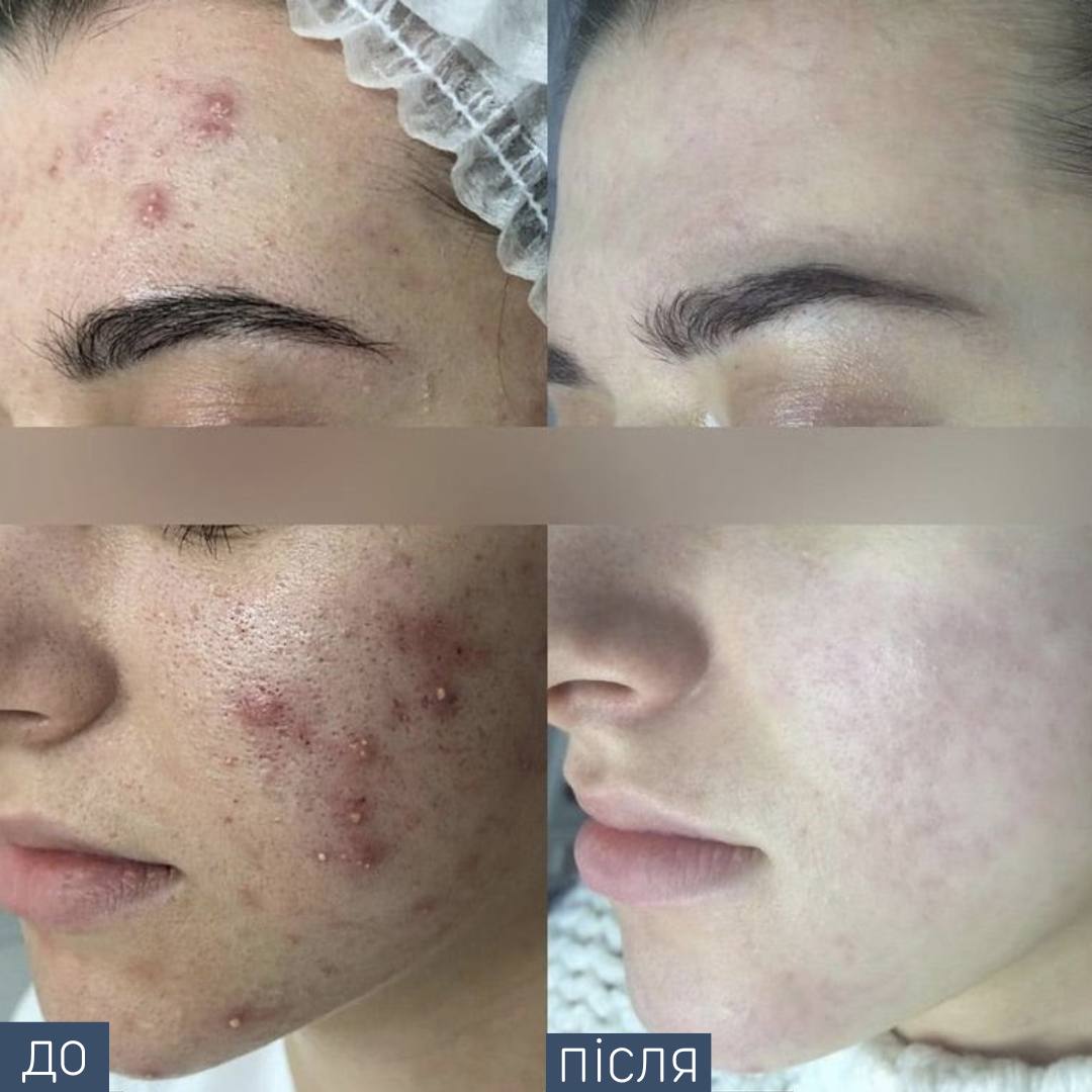 Процедура: консультація дерматолога+ курс процедур