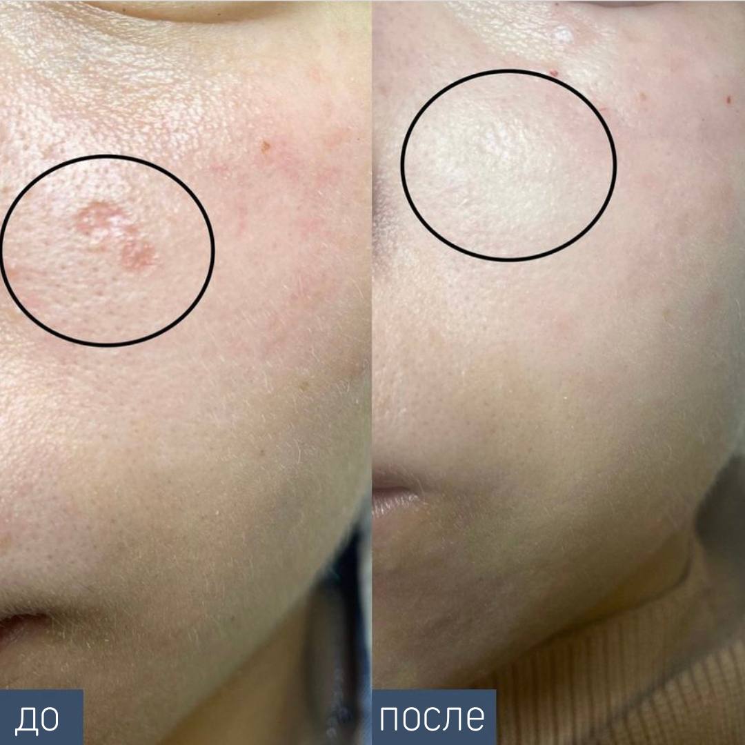 Procedure: Laser resurfacing Number of procedures: 1 Doctor: Zbirko Victoria