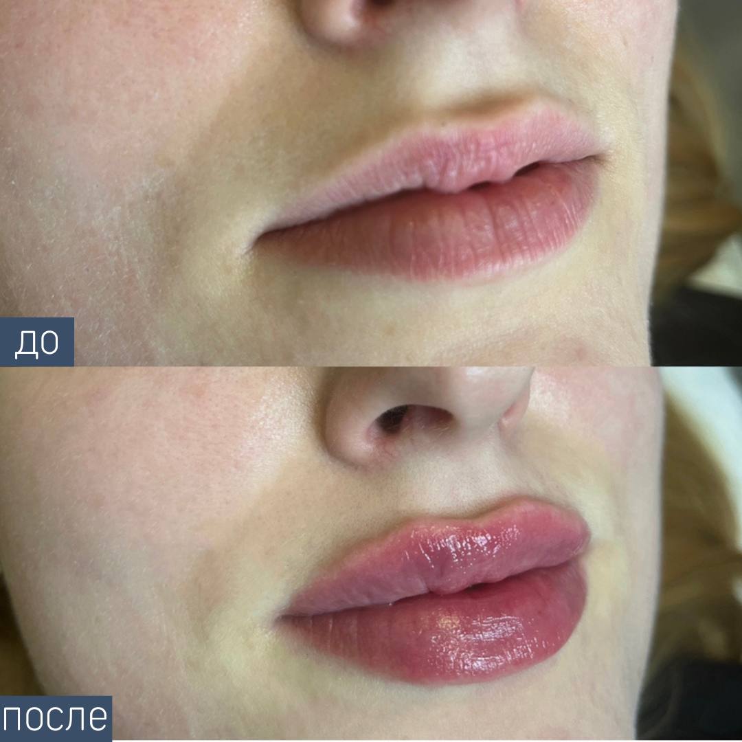 Процедура: Контурная пластика губ Препарат: Teosyal KISS, 1,0 мл Врач: Александра Гугусь