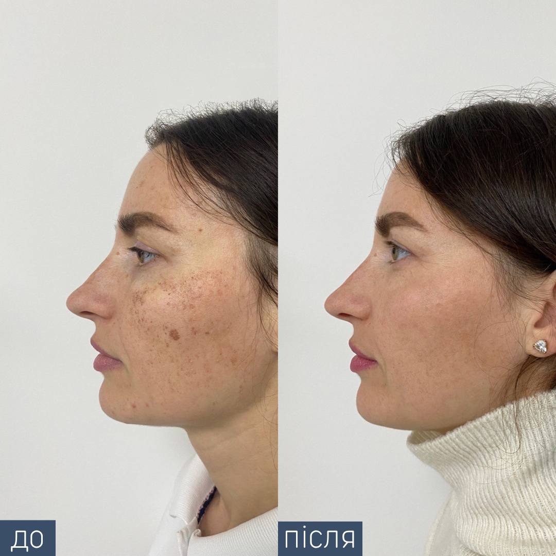 Процедура: Фотоомолодження/видалення пігментації Обладнання: BBL Sciton Кількість процедур: 1 Лікар: Олександра Гугусь