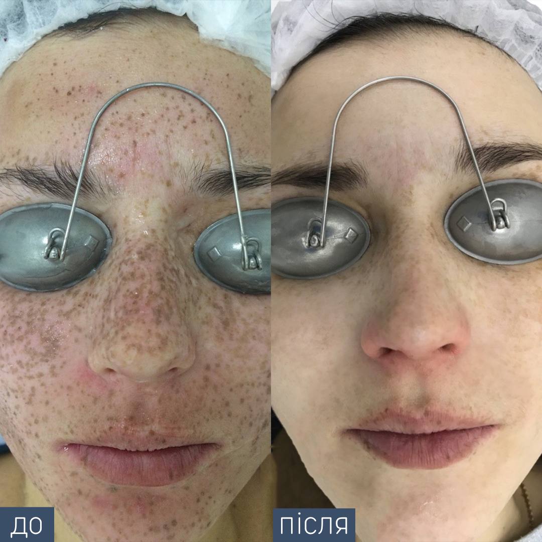 Процедура: Фотоомолодження/видалення пігментації Обладнання: BBL Sciton Кількість процедур: 2 Лікар: Наталія Синюк
