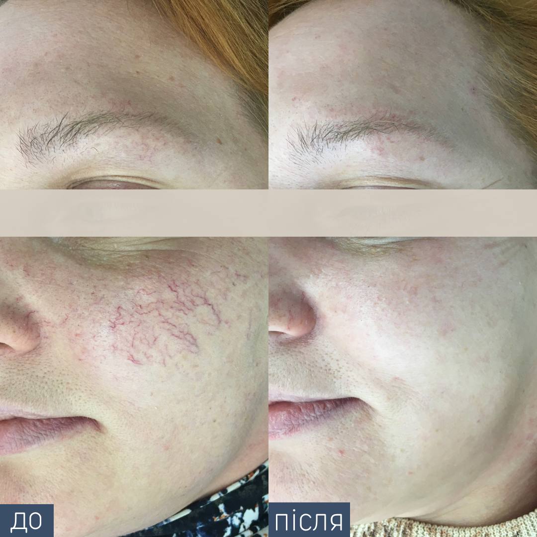 Procedure: Vascular Removal Number of Procedures: 1 Doctor: Viktoriya Zbirko