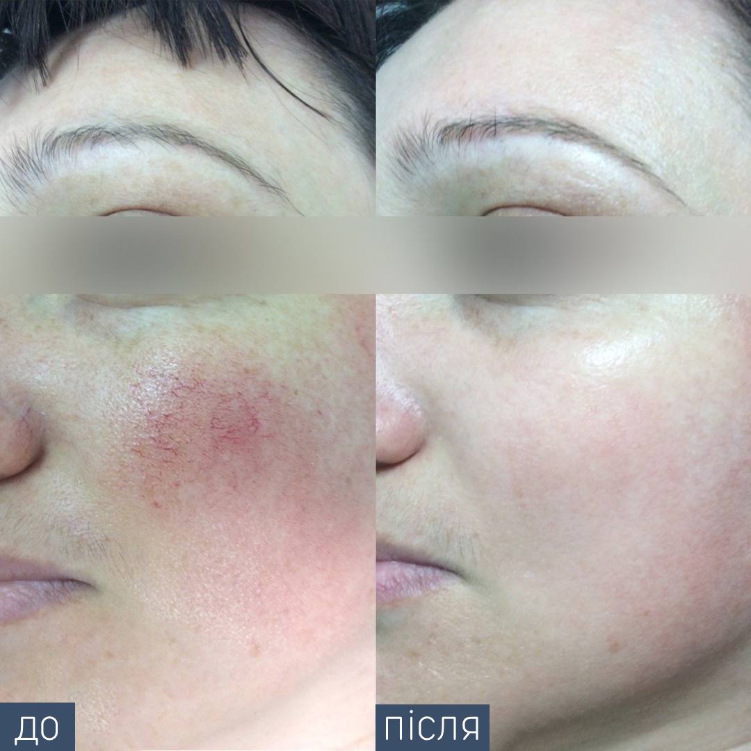 Procedure: Vascular Removal Number of Procedures: 2 Doctor: Oleksandra Gugus