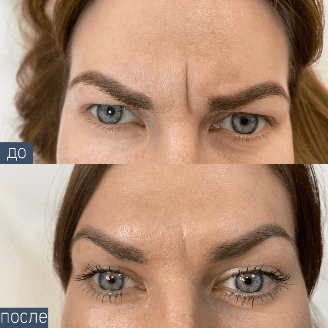 Procedure: Blanching Technique Drug: Restylane Number of procedures: 1 Doctor: Oksana Samotos