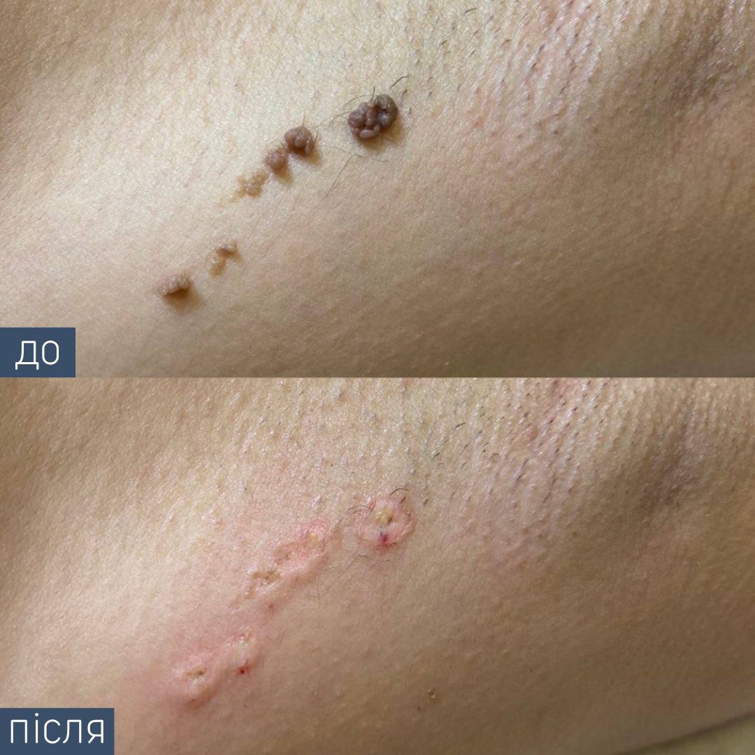 Процедура: Видалення новоутворення Метод видалення: радіохвильовий Лікар-дерматолог: Вікторія Збірко