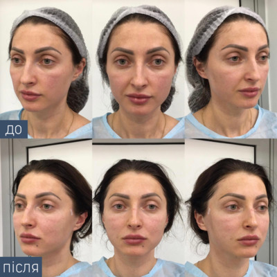 Процедура: Нитковий ліфтинг Aptos. Результат після: 3 тижні. Тривалість процедури: 2,5 год.