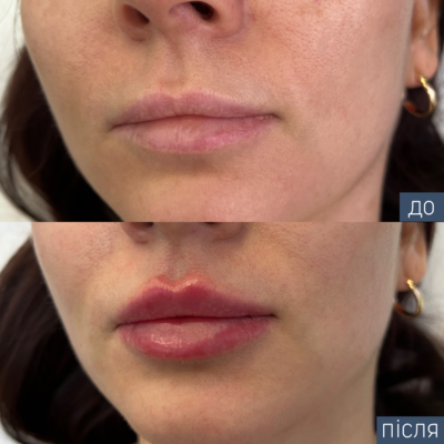 Лікар:Скочеляс Артур Процедура:Контурна пластика губ Препарат:Juviederm ultra smile