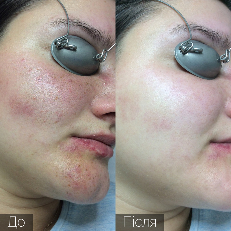 Процедура: Удаление сосудов Количество процедур: 1 Врач: Ольга Харко