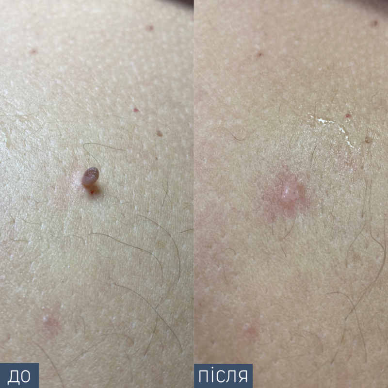 Процедура: Видалення новоутворення Метод видалення: радіохвильовий Лікар-дерматолог: Вікторія Збірко