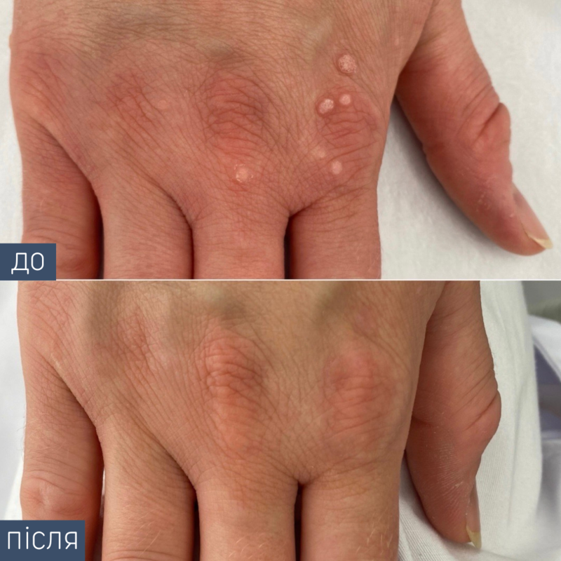 Процедура: Удаление новообразования Метод удаления: криодеструктор Врач-дерматолог: Виктория Збирко