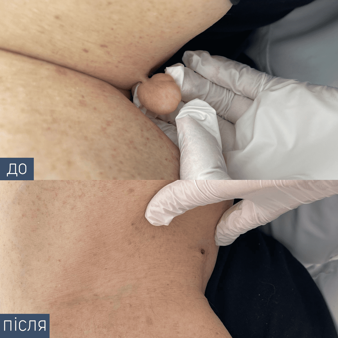 Процедура: Видалення новоутворення Метод видалення: радіохвильовий Лікар-дерматолог: Наталія Синюк