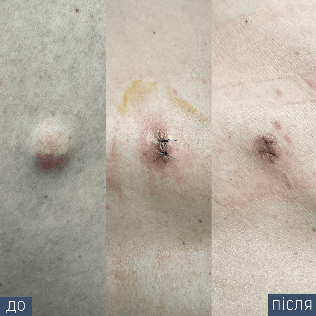 Процедура: Видалення новоутворення Метод видалення: хірургічний Лікар-хірург: Святослав Синюк