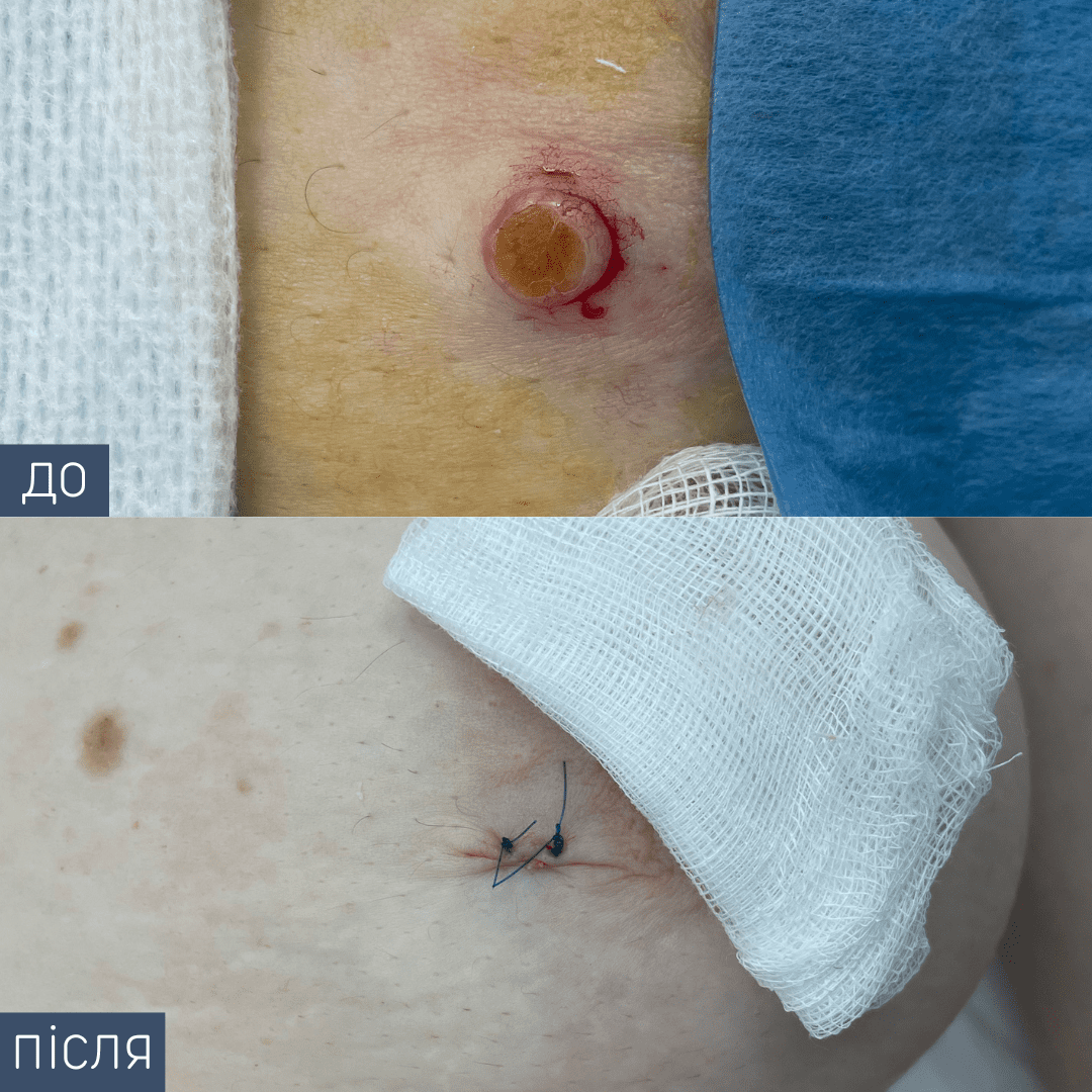 Процедура: Видалення новоутворення Метод видалення: хірургічний Лікар-хірург: Святослав Синюк