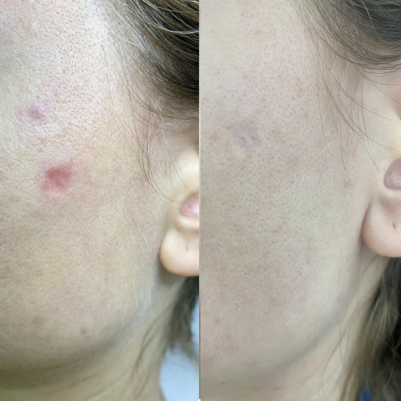 Процедура: Лазерная шлифовка и фототерапия Количество процедур: 2 Врач: Харко Ольга