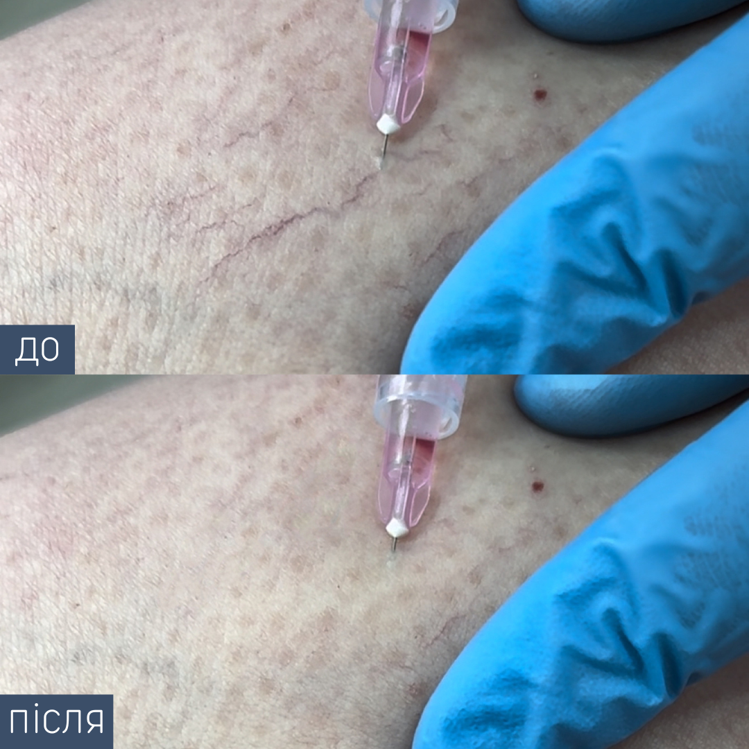 Лікар-хірург Склеротерапія одна процедура 0,5 мл